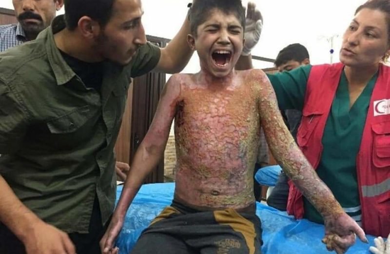 Turkey Committing War crimes in Syria. Child with burn injuries due to chemical weapons being treated in the hospital.