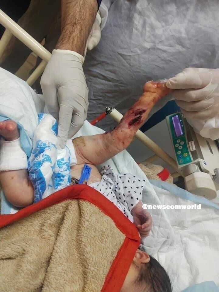New Born Babies injured by the Pakistan Supported Taliban Terrorists in an attack on 100-bed Maternity Hospital in Kabul